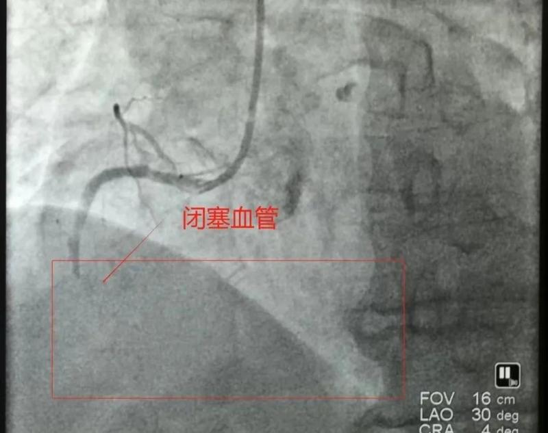 【卓越医疗】仅14分钟，我院胸痛中心团队与时间赛跑，再刷心梗抢救速度