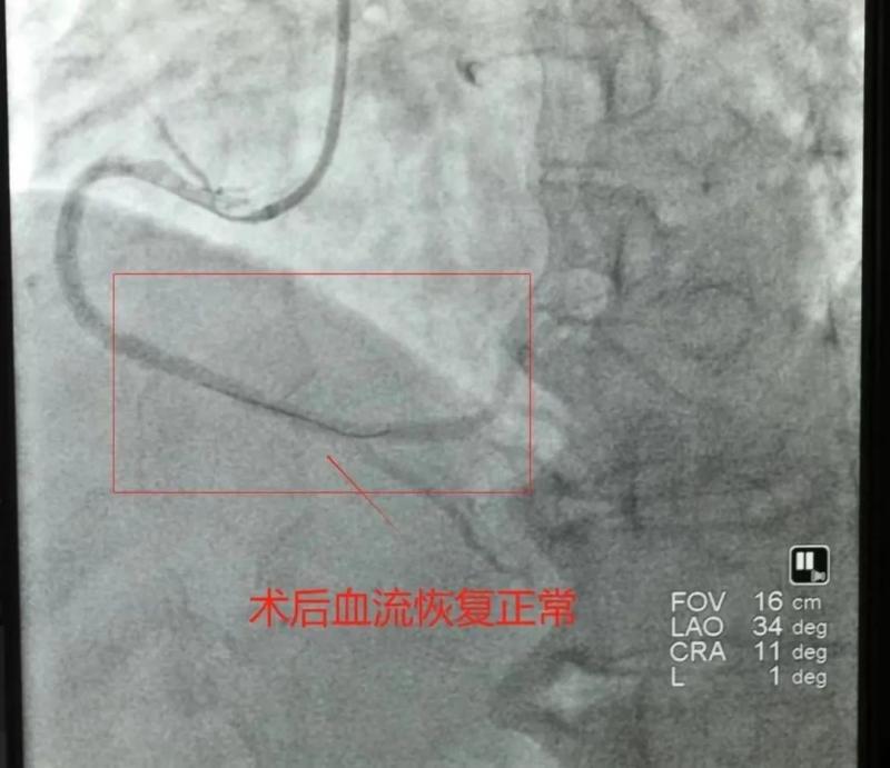 【卓越医疗】仅14分钟，我院胸痛中心团队与时间赛跑，再刷心梗抢救速度