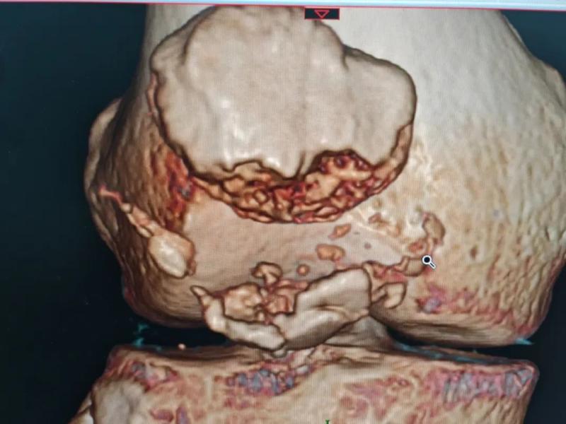 【中心医院·医者红】这项新技术，让患者重拾“膝”望